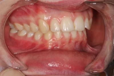 zęby po leczeniu 1