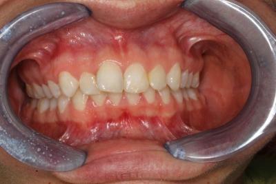 zęby po leczeniu 10