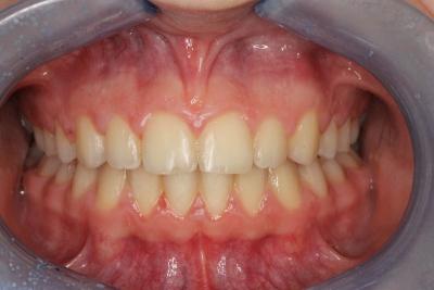 zęby po leczeniu 12