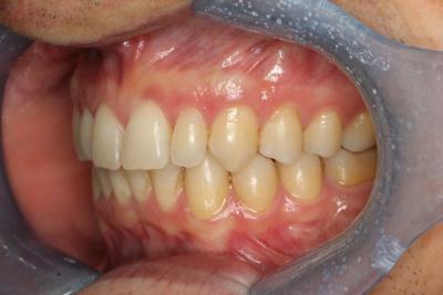 zęby po leczeniu 18