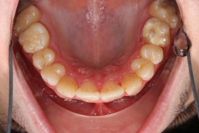 zęby po leczeniu 20