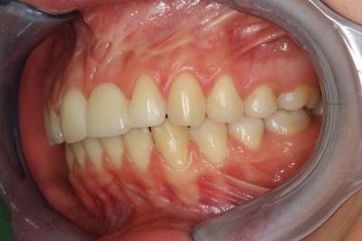 zęby po leczeniu 4