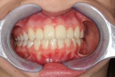 zęby po leczeniu 5