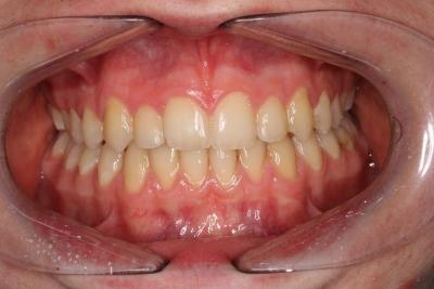 zęby po leczeniu 7