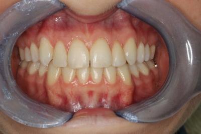 zęby po leczeniu 8