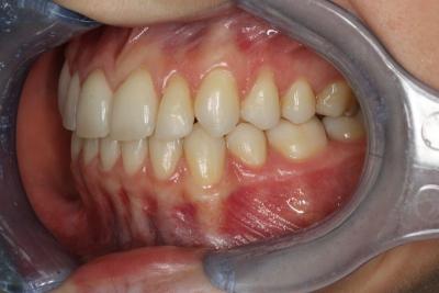 zęby po leczeniu 9