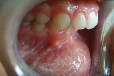 zęby przed leczeniem 1