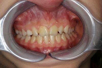 zęby przed leczeniem 15