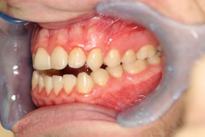 zęby przed leczeniem 17