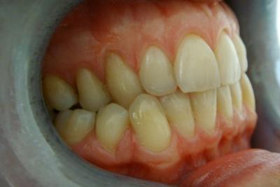 zęby przed leczeniem 2