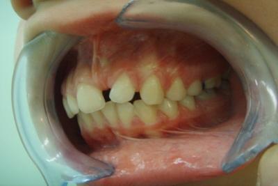 zęby przed leczeniem 22