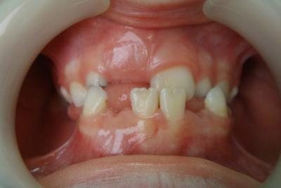 zęby przed leczeniem 3